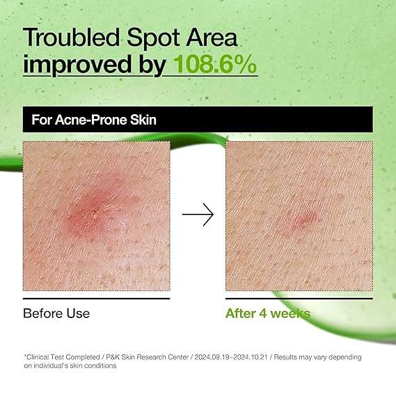 [Anua] Azelaic Acid 10 Hyaluron Redness Soothing Serum 1.01 fl oz (30ml)