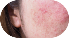 Acne Prone Skin